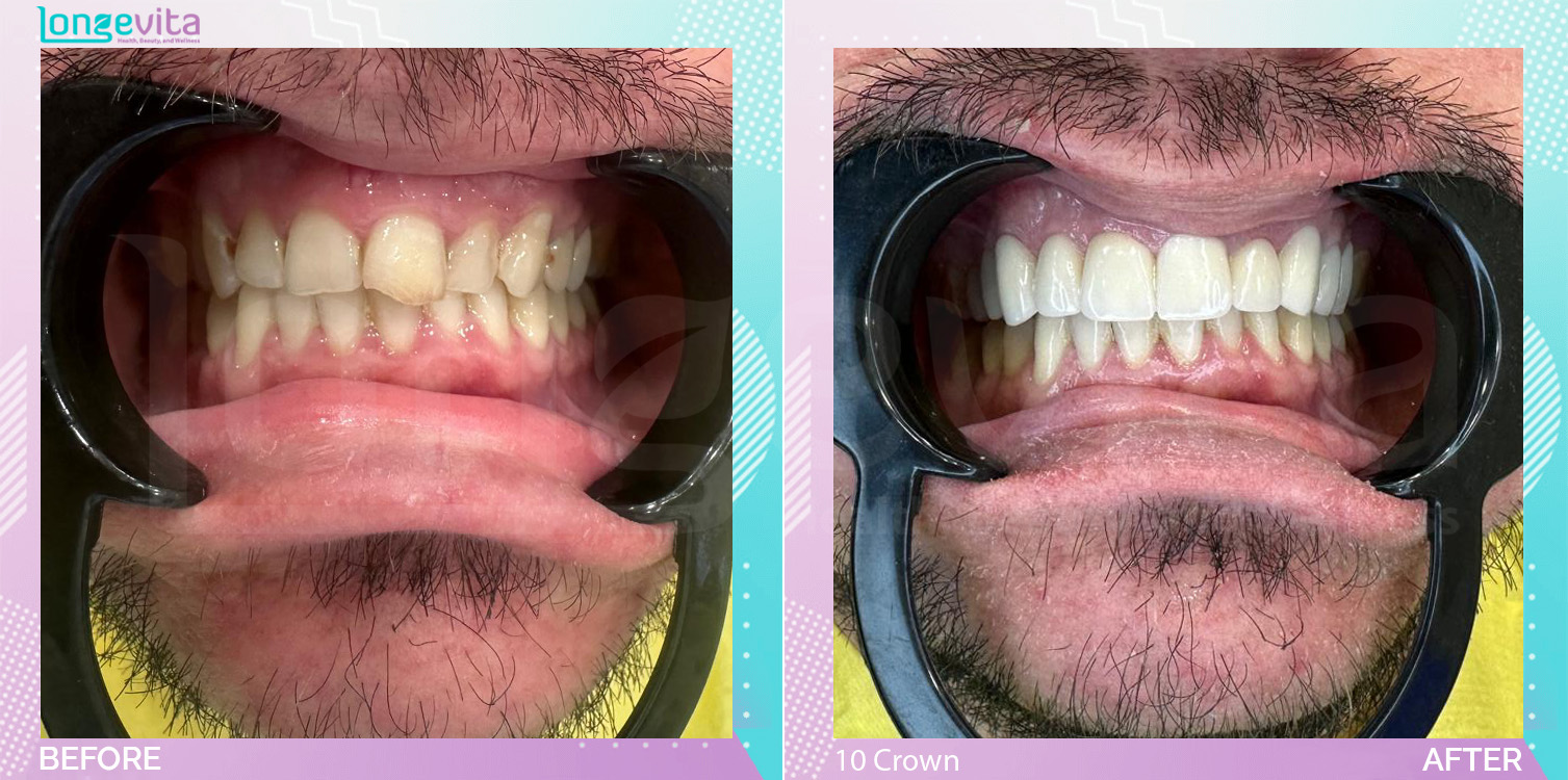 Crowns and Root Canal before and after, 3 root canal + 10 Porcelain Crowns units, 30s male patient