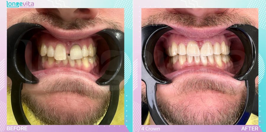 Crowns and Whitening before and after, Whitening + 4 porcelain crowns units, 30s male patient