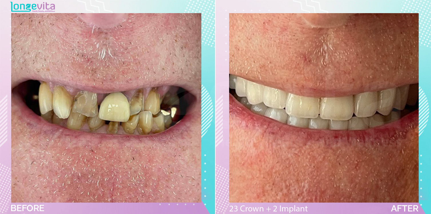 Crowns and Hollywood Smile before and after, 23 Porcelain Crown + 2 Implant units, 60s male patient