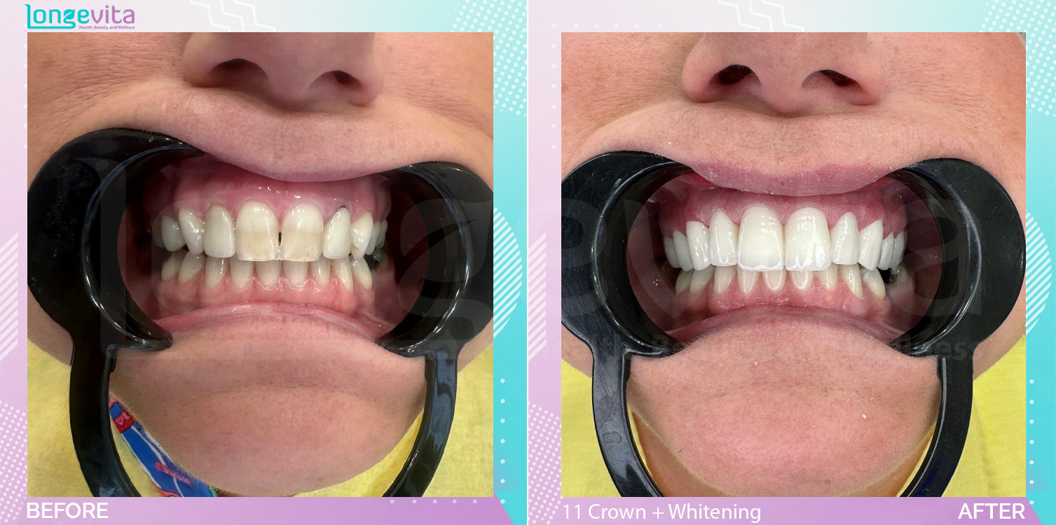Crowns and Whitening before and after, 11 Porcelain Crowns + teeth whitening units, 40s female patient