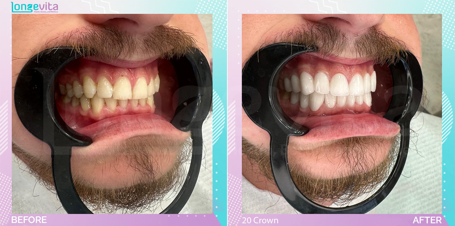 Crowns before and after, 20 Porcelain Crowns units, 20s male patient
