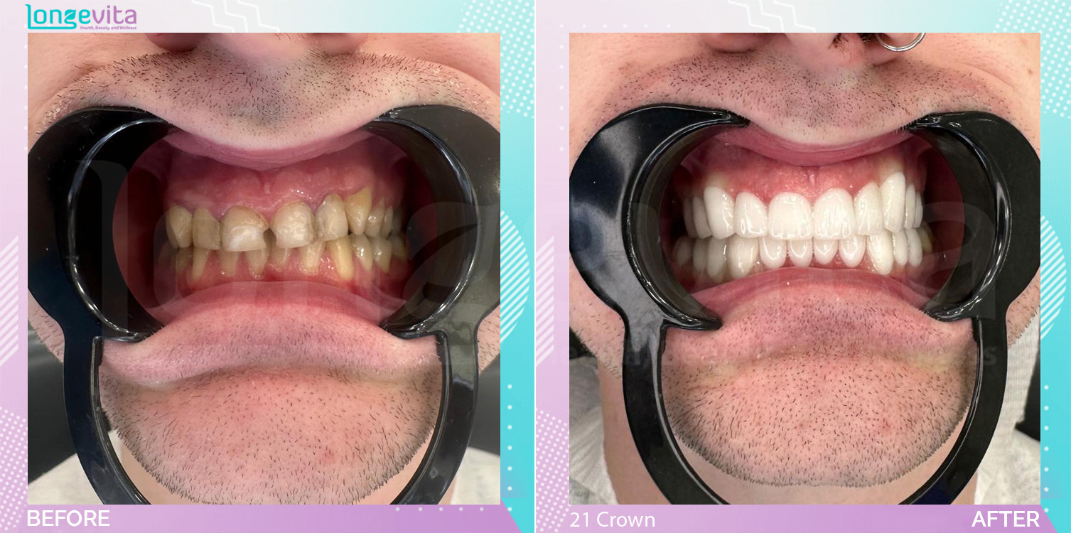 Crowns before and after, 21 Porcelain Crowns units, 20s male patient