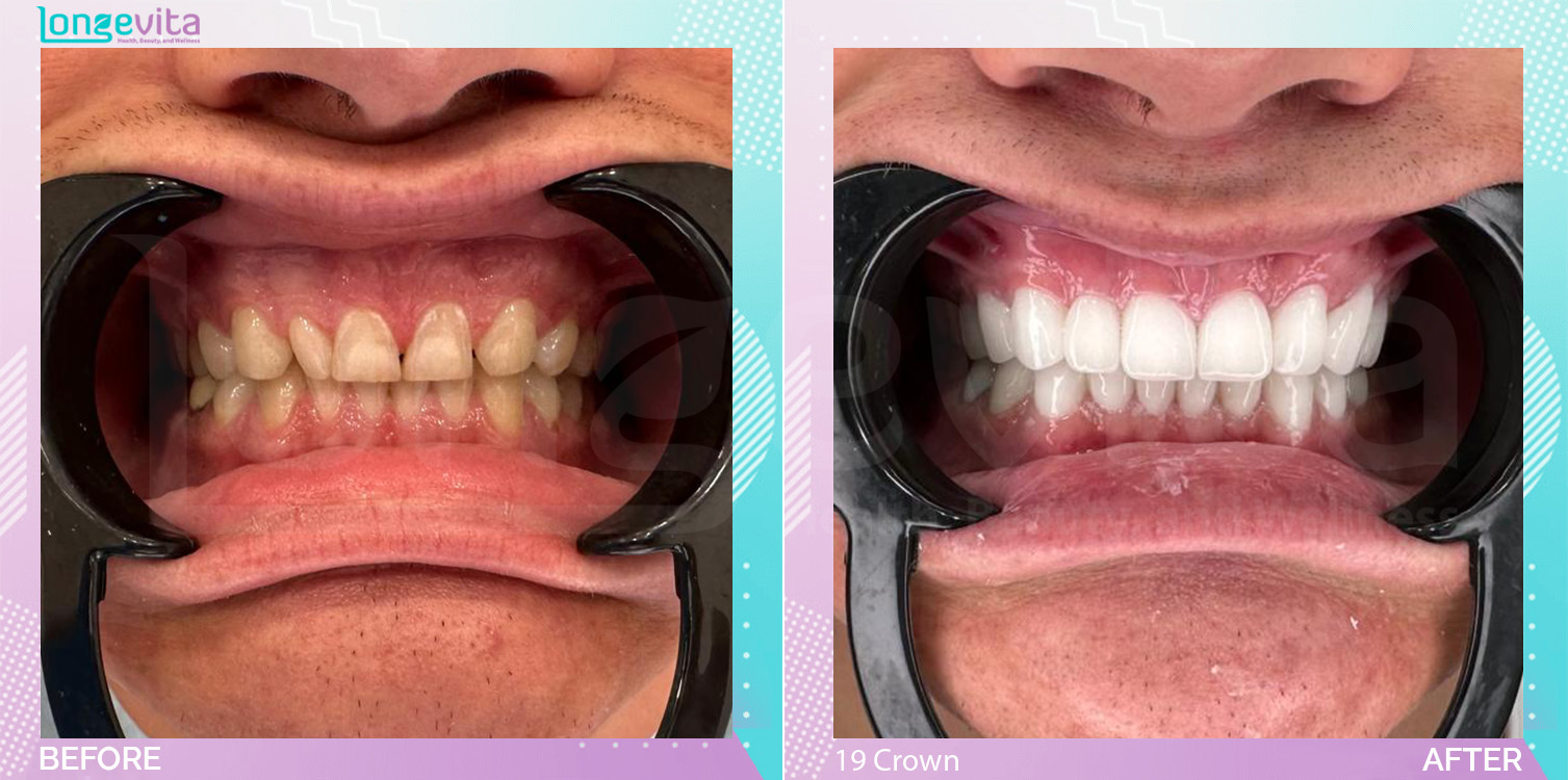 Crowns and Hollywood Smile before and after, 19 Porcelain Crowns units, 20s male patient