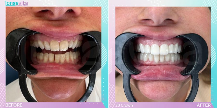 Crowns before and after, 20 Porcelain Crowns units, 40s female patient