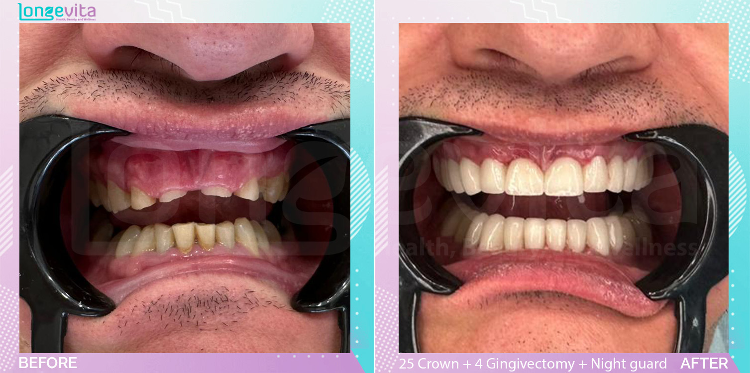 Crowns and Gingivectomy and Nightguard before and after, 25 Porcelain Crowns + 4 Gingivectomy + Night Guard units, 40s male patient