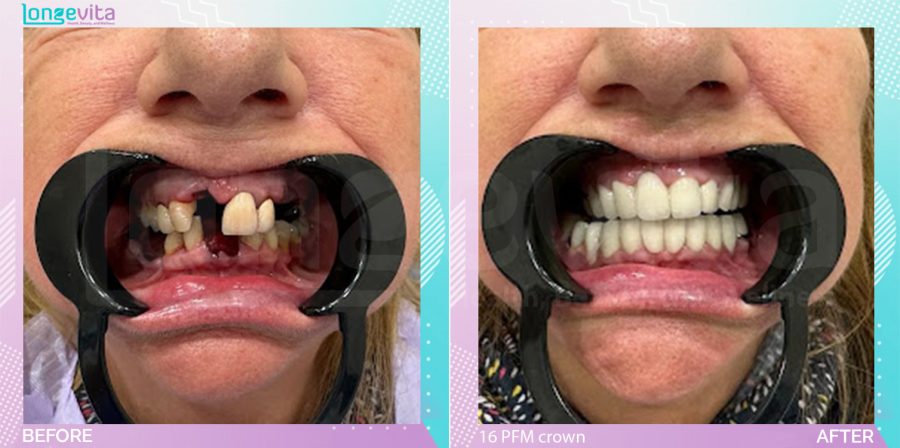 Crowns and Dentures and Extraction before and after, 16 Porcelain fused to metal crowns + 2 dentures + 2 extraction units, 60s female patient