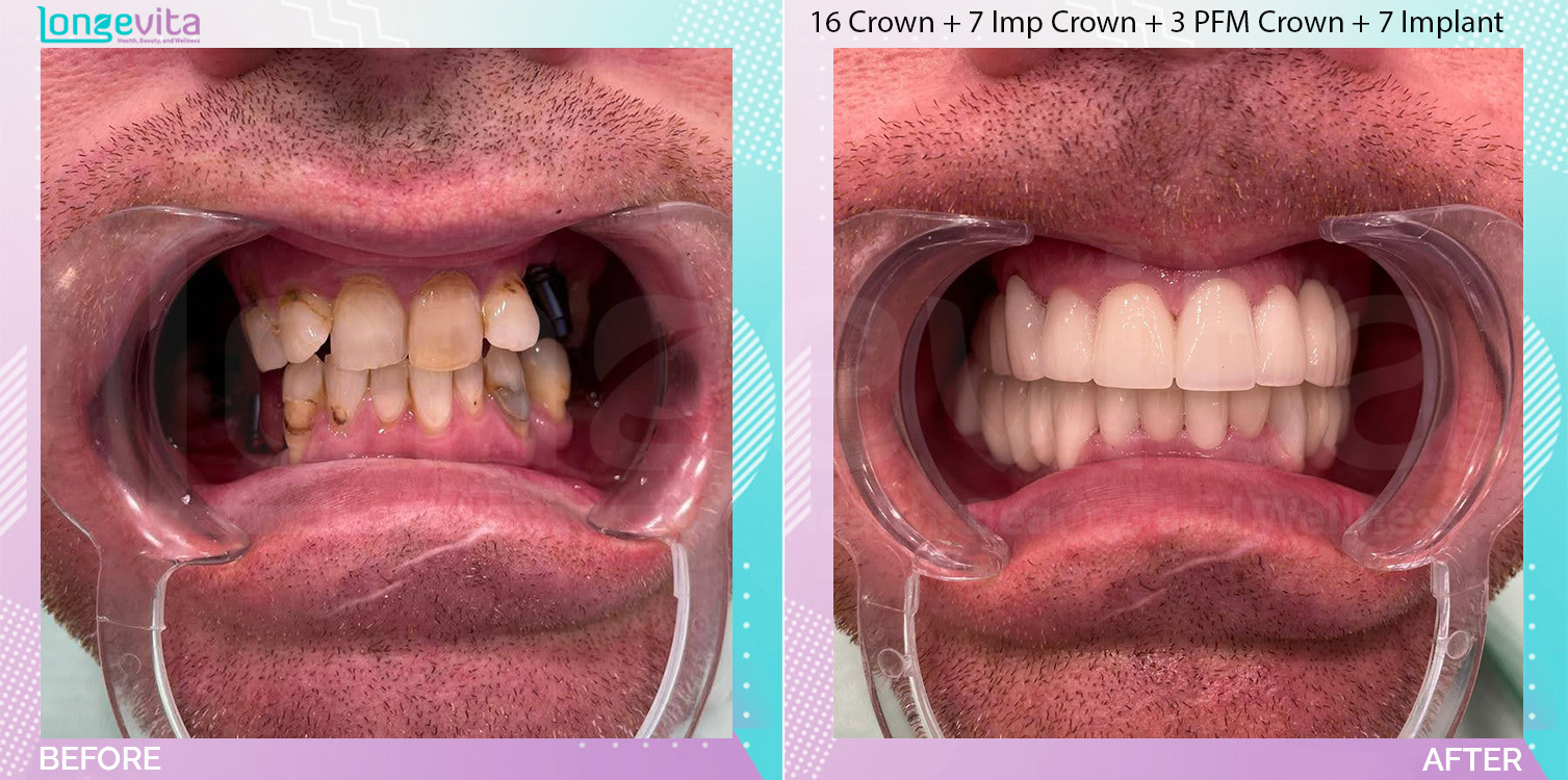 Crowns and Extraction and Implant Crown and Implants and Root Canal before and after, 16 Porcelain Crowns + 7 Implant Crown + 3 porcelain fused to metal crown + 7 dental implant + Root Canal + 2 Extraction units, 40s male patient