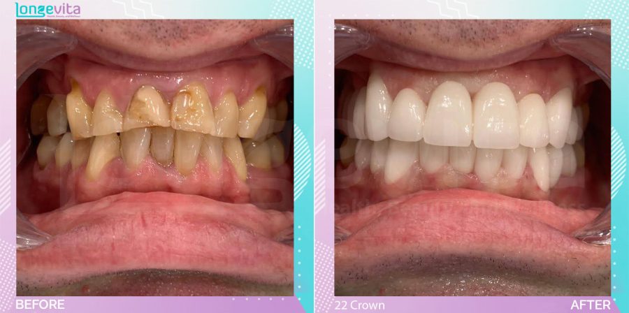 Crowns and Hollywood Smile before and after, 22 Porcelain Crown units, 40s male patient