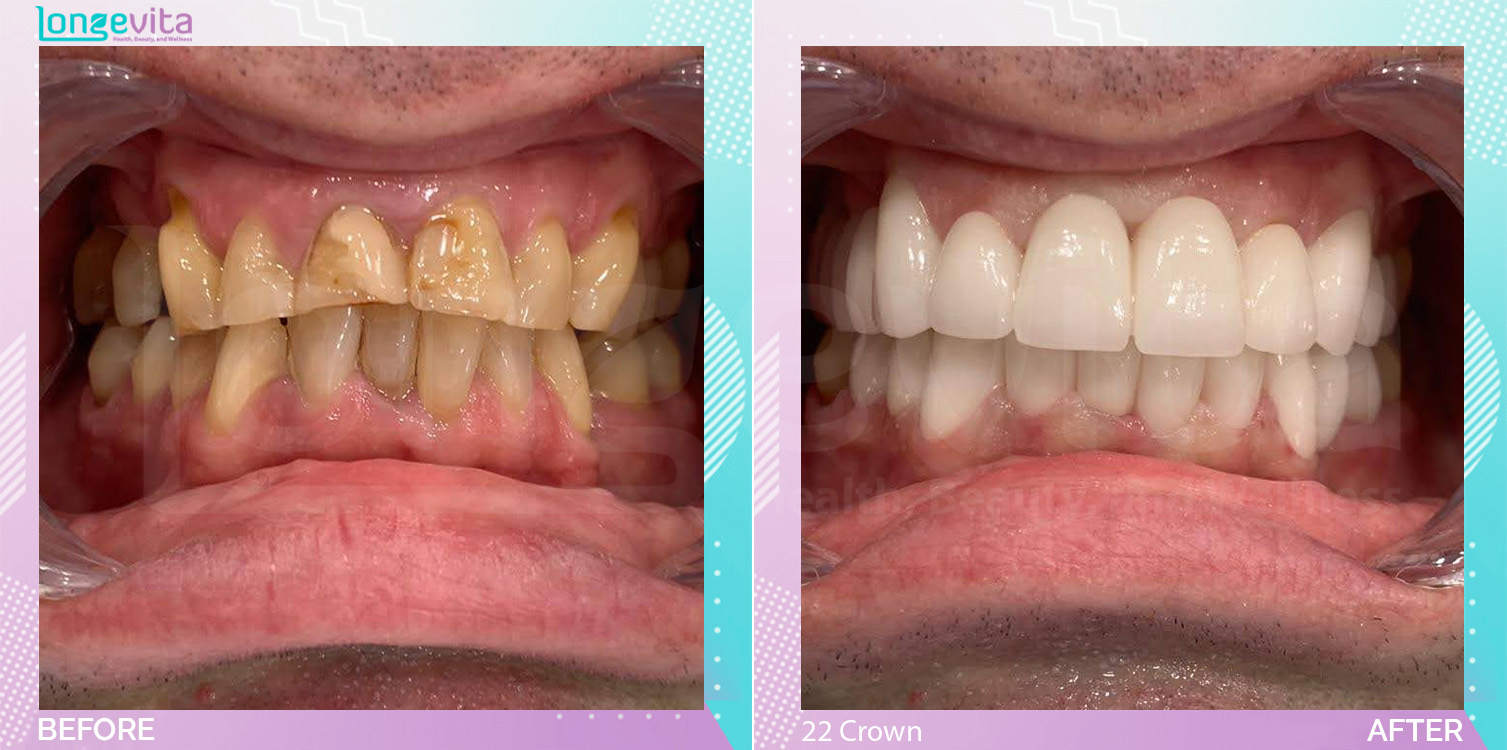Crowns and Hollywood Smile before and after, 22 Porcelain Crown units, 40s male patient
