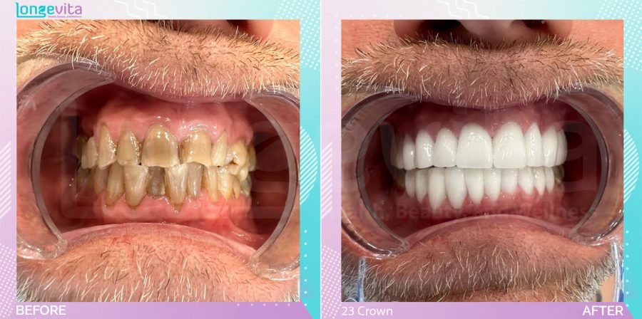 Crowns and Hollywood Smile before and after, 23 Porcelain Crown units, 50s male patient