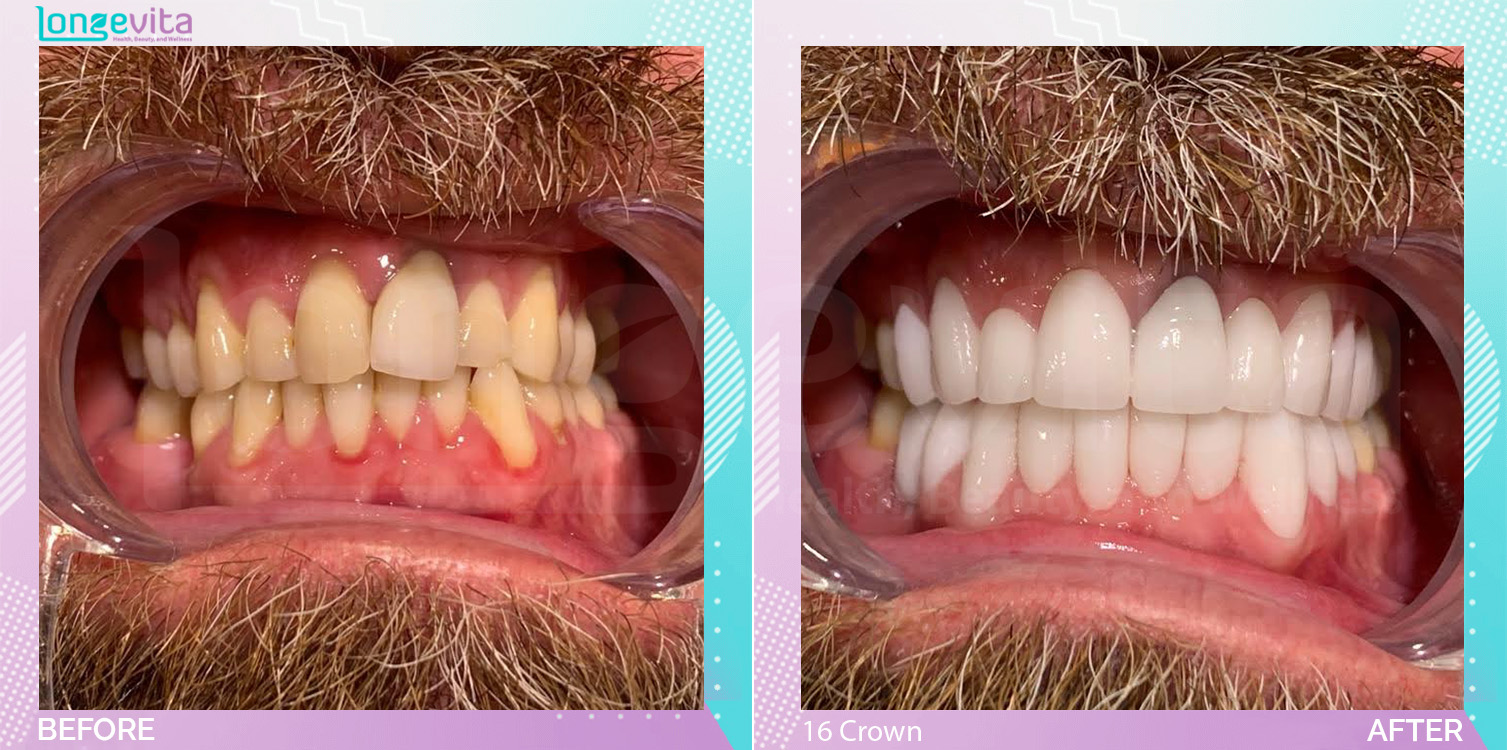 Crowns before and after, 16 Porcelain Crown units
