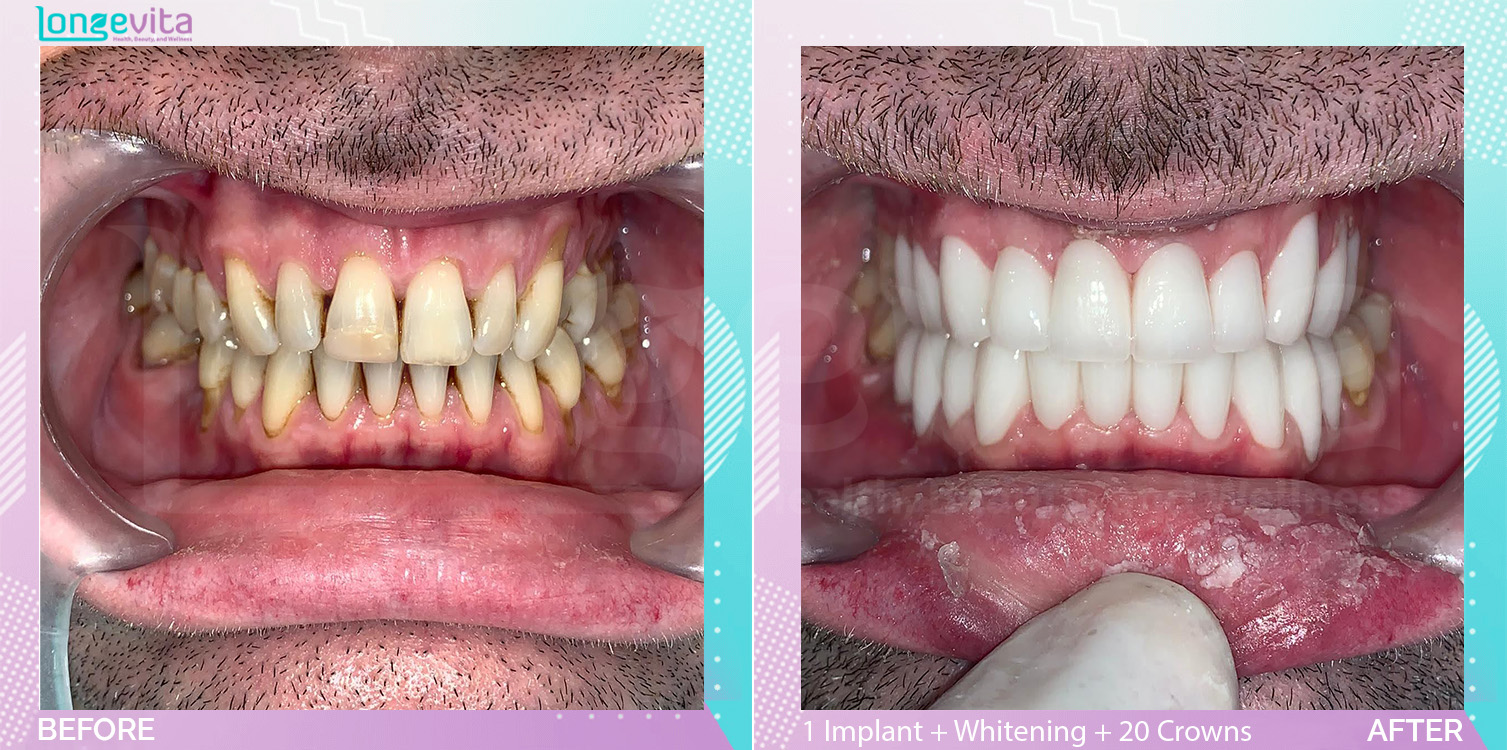 Crowns and Implants and Whitening before and after, 1 Implant + Teeth Whitening + 20 Porcelain Crowns units