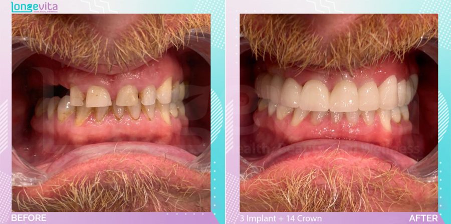 Crowns and Implants and Nightguard before and after, 3 Implant + 14 Porcelain Crown+ TW+ Sinus Lift+ 1 Bone Augmentation + 1 Nightguard units, 40s male patient