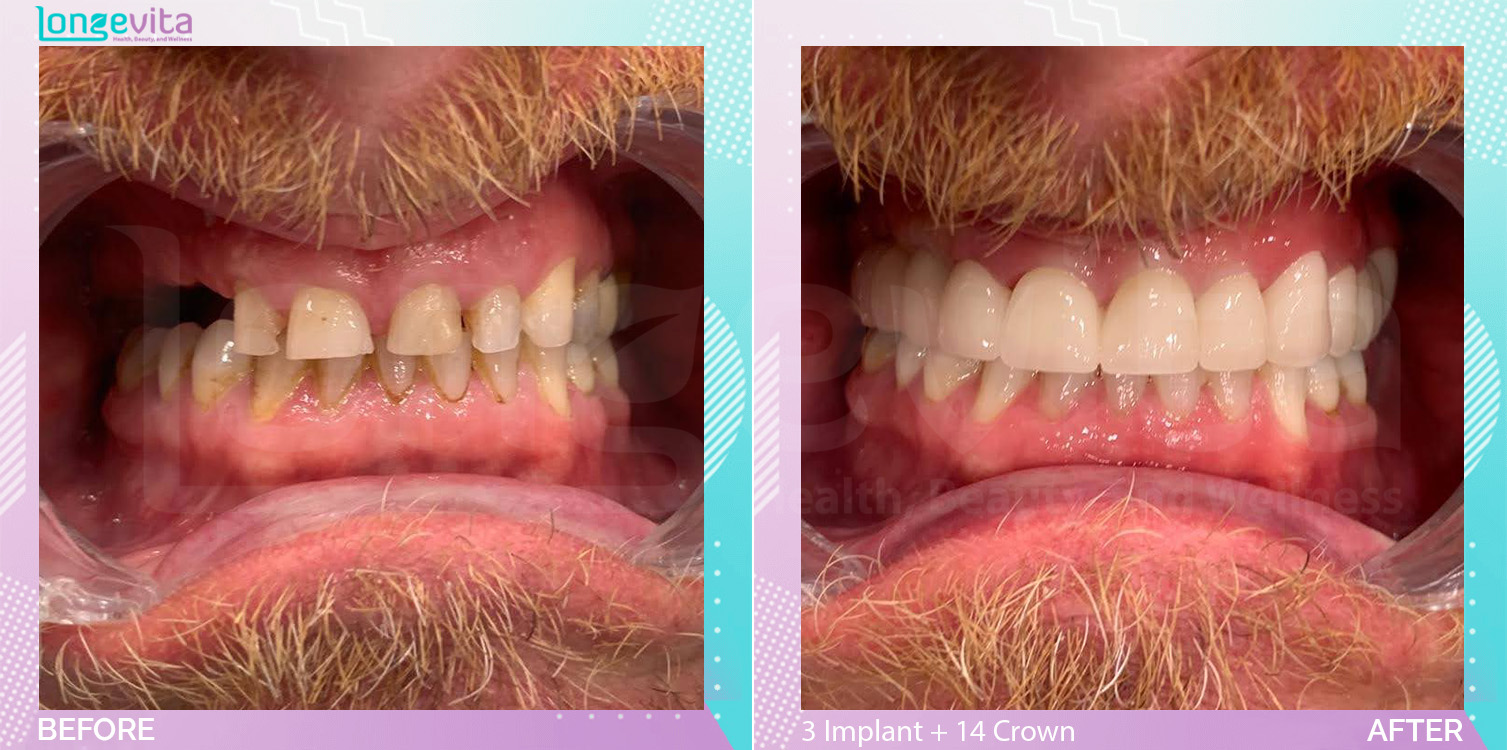 Crowns and Implants and Nightguard before and after, 3 Implant + 14 Porcelain Crown+ TW+ Sinus Lift+ 1 Bone Augmentation + 1 Nightguard units, 40s male patient