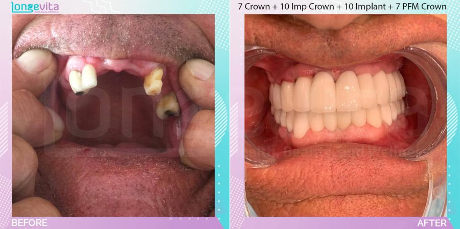Crowns and Dentures and Extraction and Implants before and after, 7 Porcelain Crowns + 10 Implant Crown + 10 Dental Implant + 9 Extraction + 2 dentures + 7 Porcelain Fused to Metal Crown units