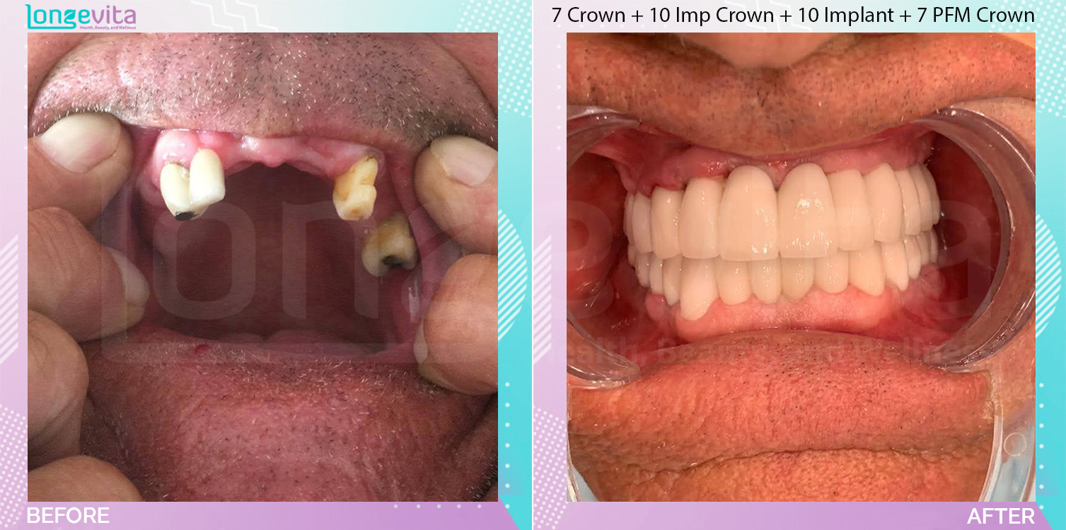 Crowns and Dentures and Extraction and Implants before and after, 7 Porcelain Crowns + 10 Implant Crown + 10 Dental Implant + 9 Extraction + 2 dentures + 7 Porcelain Fused to Metal Crown units