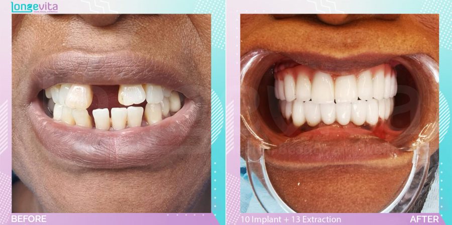Extraction and Implants before and after, 12 Implant + 18 Implant crown + 8 Porcelain Crown + 17 extraction + 2 bone augmentation + sinus lift units, 50s female patient