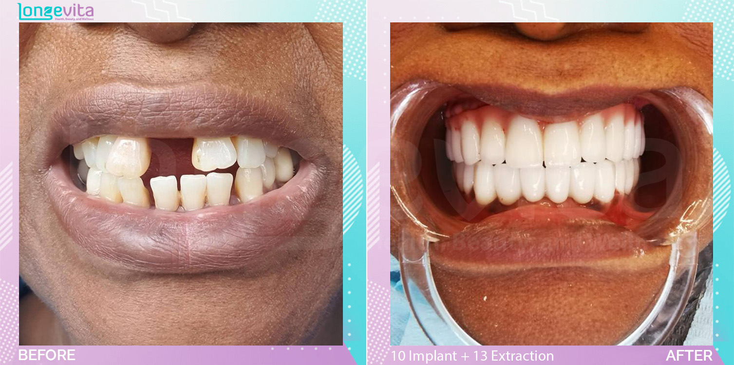 Extraction and Implants before and after, 12 Implant + 18 Implant crown + 8 Porcelain Crown + 17 extraction + 2 bone augmentation + sinus lift units, 50s female patient