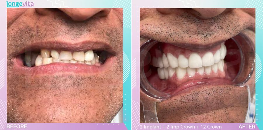 Crowns and Implant Crown and Implants and Root Canal before and after, 4 Implant + 2 Implant Crown + 21 Porcelain Crown + Root Canal + Cyst Removal units, 40s male patient
