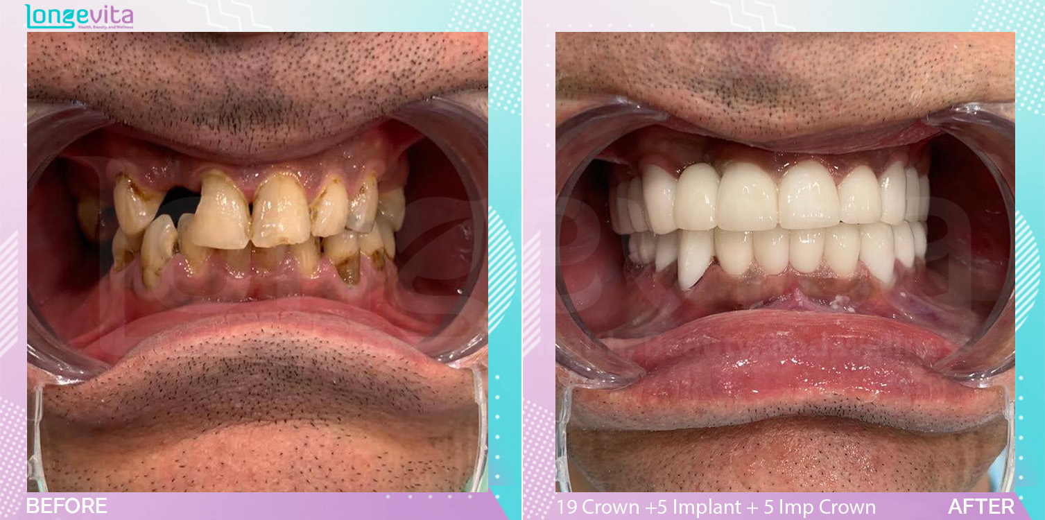 Crowns and Extraction and Implant Crown and Implants before and after, 19 Porcelain Crown +5 Dental Implant + 5 Implant Crown + 3 Extraction + 8 root canal units, 40s male patient