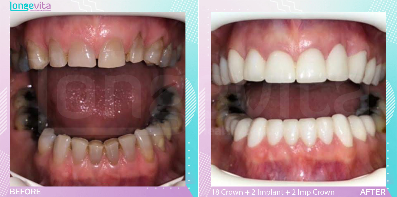 Crowns and Implant Crown and Implants before and after, 19 Porcelain Crown + 2 Dental Implant + 2 Implant Crown units, 50s female patient