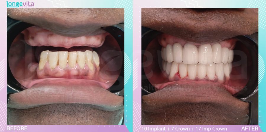 Crowns and Implant Crown and Implants before and after, 10 Implant + 7 Porcelain Crown + 17 Implant Crown units, 50s male patient