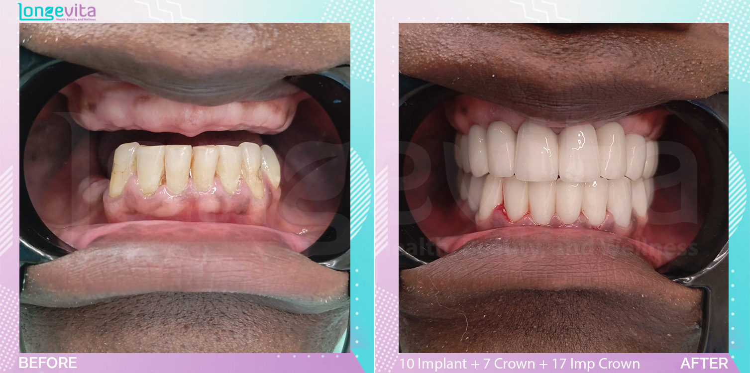 Crowns and Implant Crown and Implants before and after, 10 Implant + 7 Porcelain Crown + 17 Implant Crown units, 50s male patient