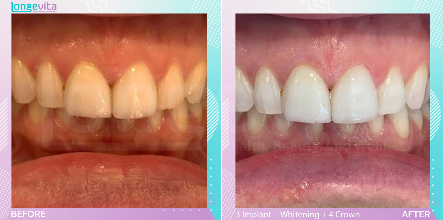 Extraction and Implant Crown and Implants and Whitening before and after, 3 Dental Implant +  2 teeth whitening + Extraction + 3 Implant Crowns + Porcelain Crown units, 30s female patient