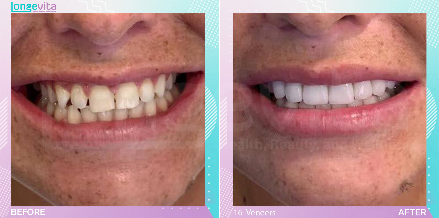 Veneers before and after, 16 Porcelain Veneers units, 20s female patient