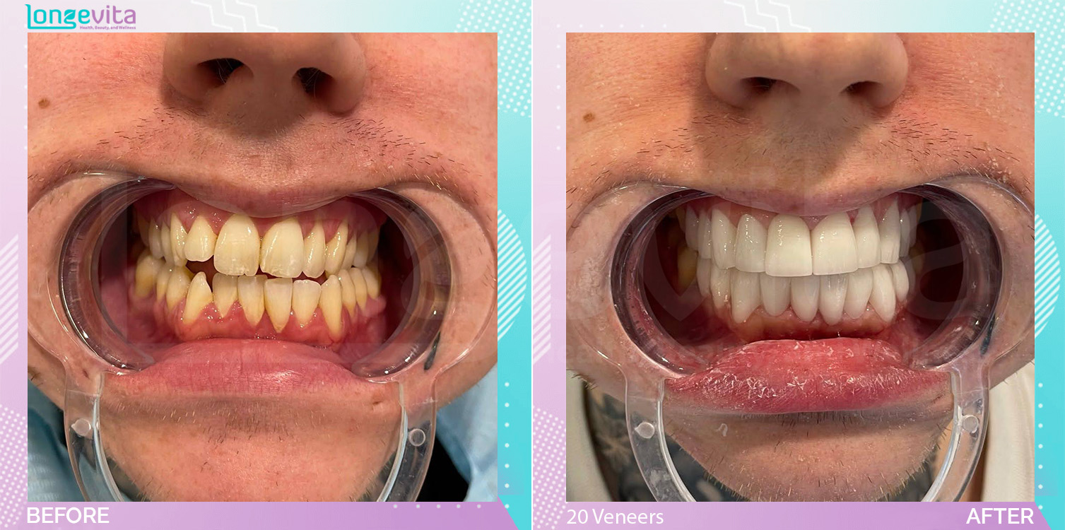 Hollywood Smile and Veneers before and after, 20 Laminate Veneers units, 20s male patient