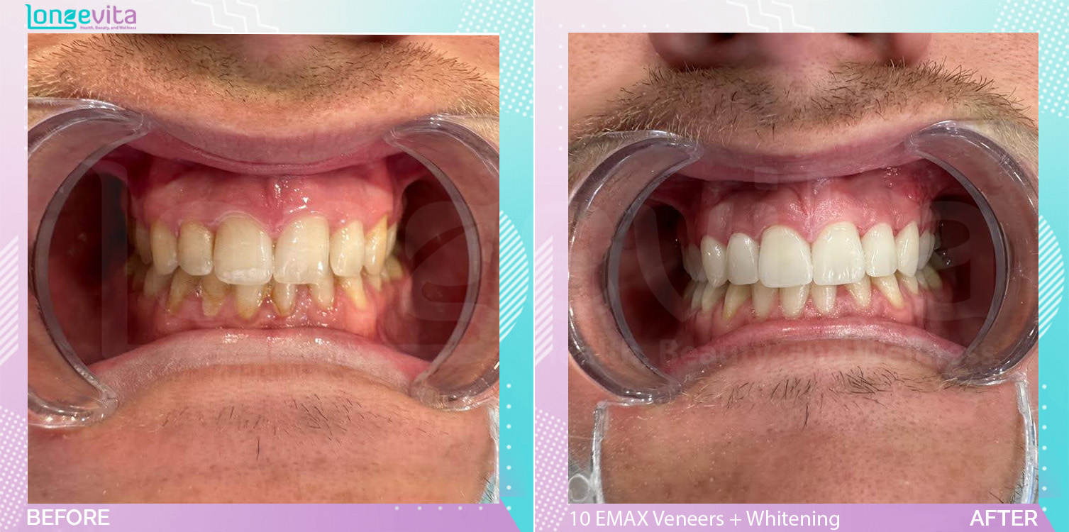 Veneers and Whitening before and after, 10 EMAX Laminate Veneers + TW units, 20s male patient