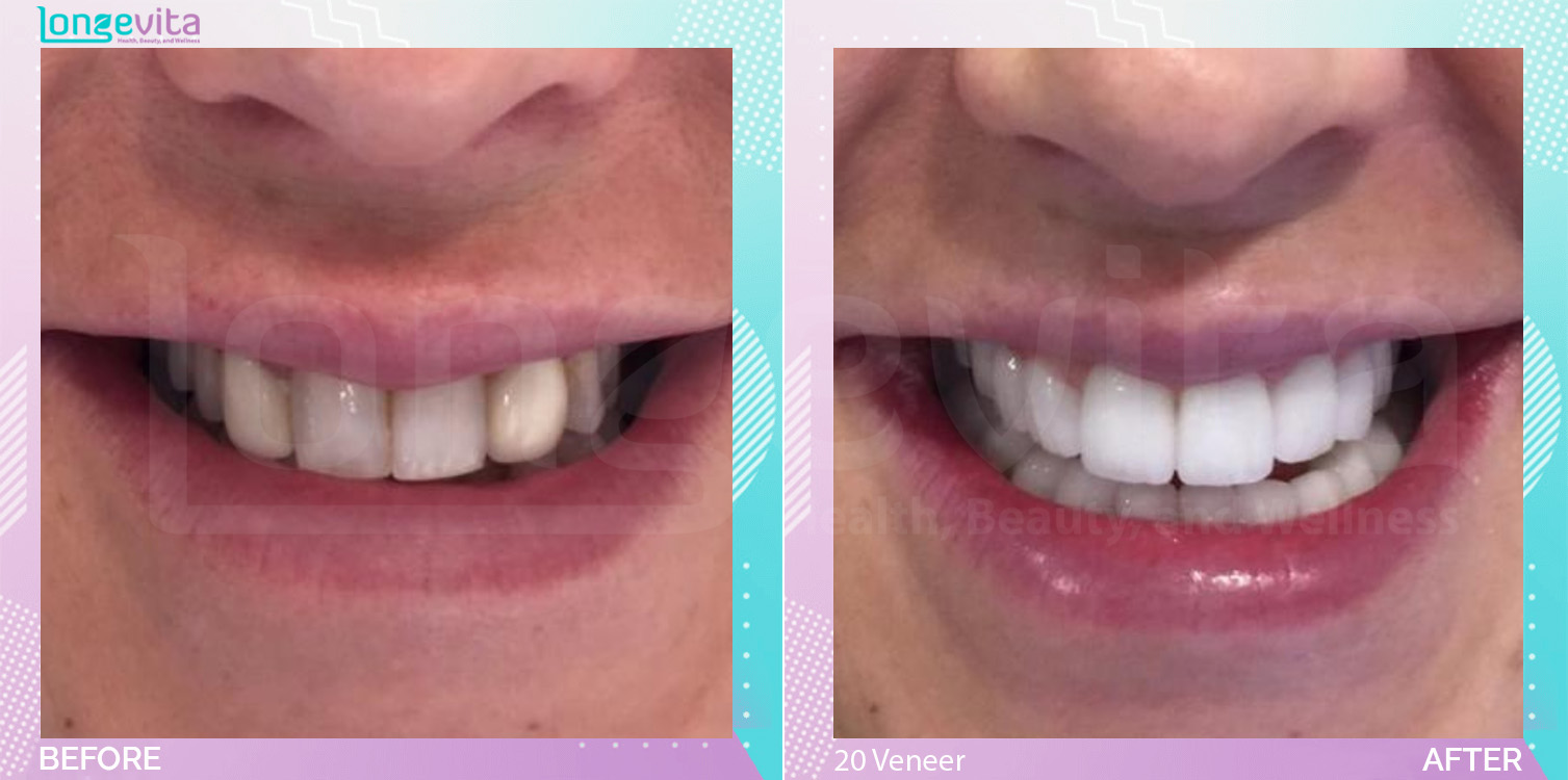 Hollywood Smile and Veneers and Whitening before and after, 20 Porcelain Veneers + filling units