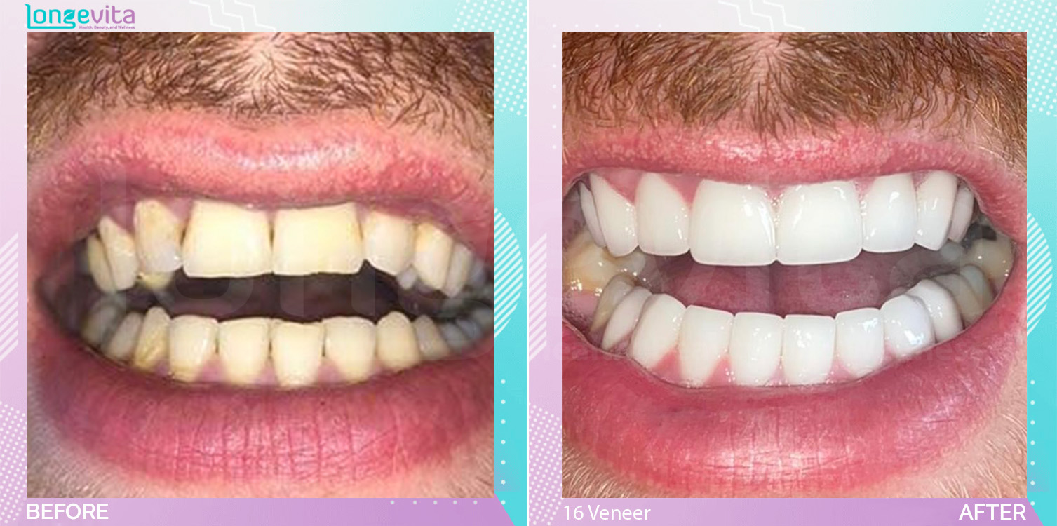 Veneers before and after, 16 Porcelain Veneers units, 20s male patient