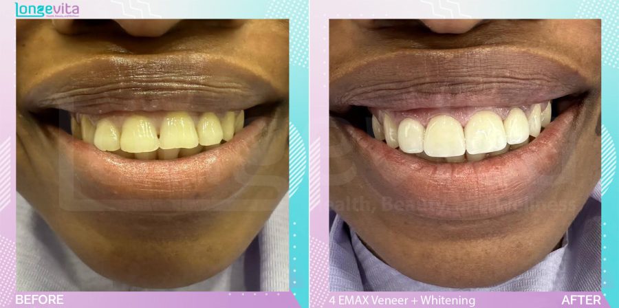 Veneers and Whitening before and after, 4 EMAX Laminate Veneers + Teeth Whitening units, 30s male patient