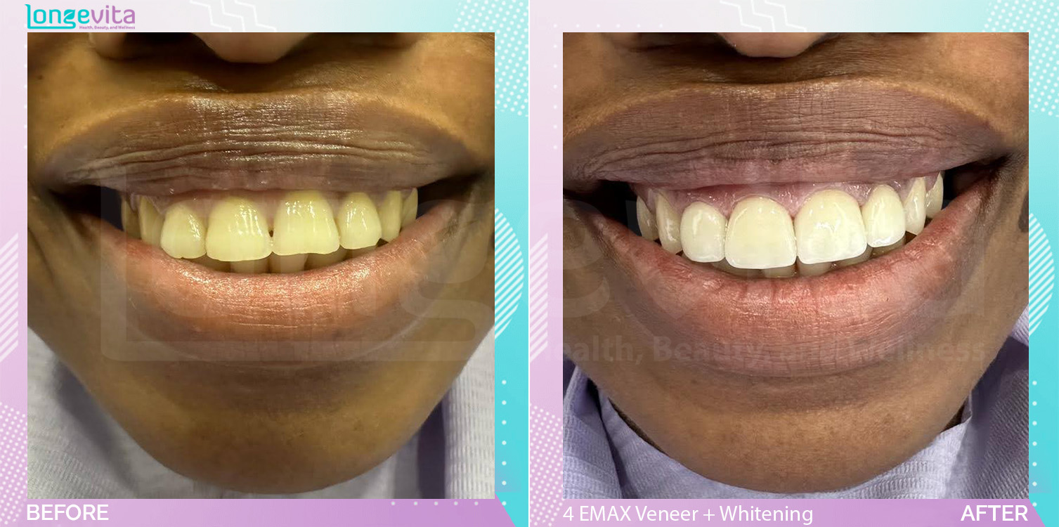 Veneers and Whitening before and after, 4 EMAX Laminate Veneers + Teeth Whitening units, 30s male patient
