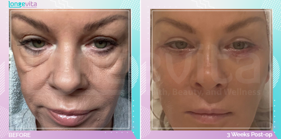 Eyelid and Facelift before and after, Face