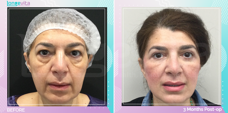 Eyelid and Facelift before and after, Face