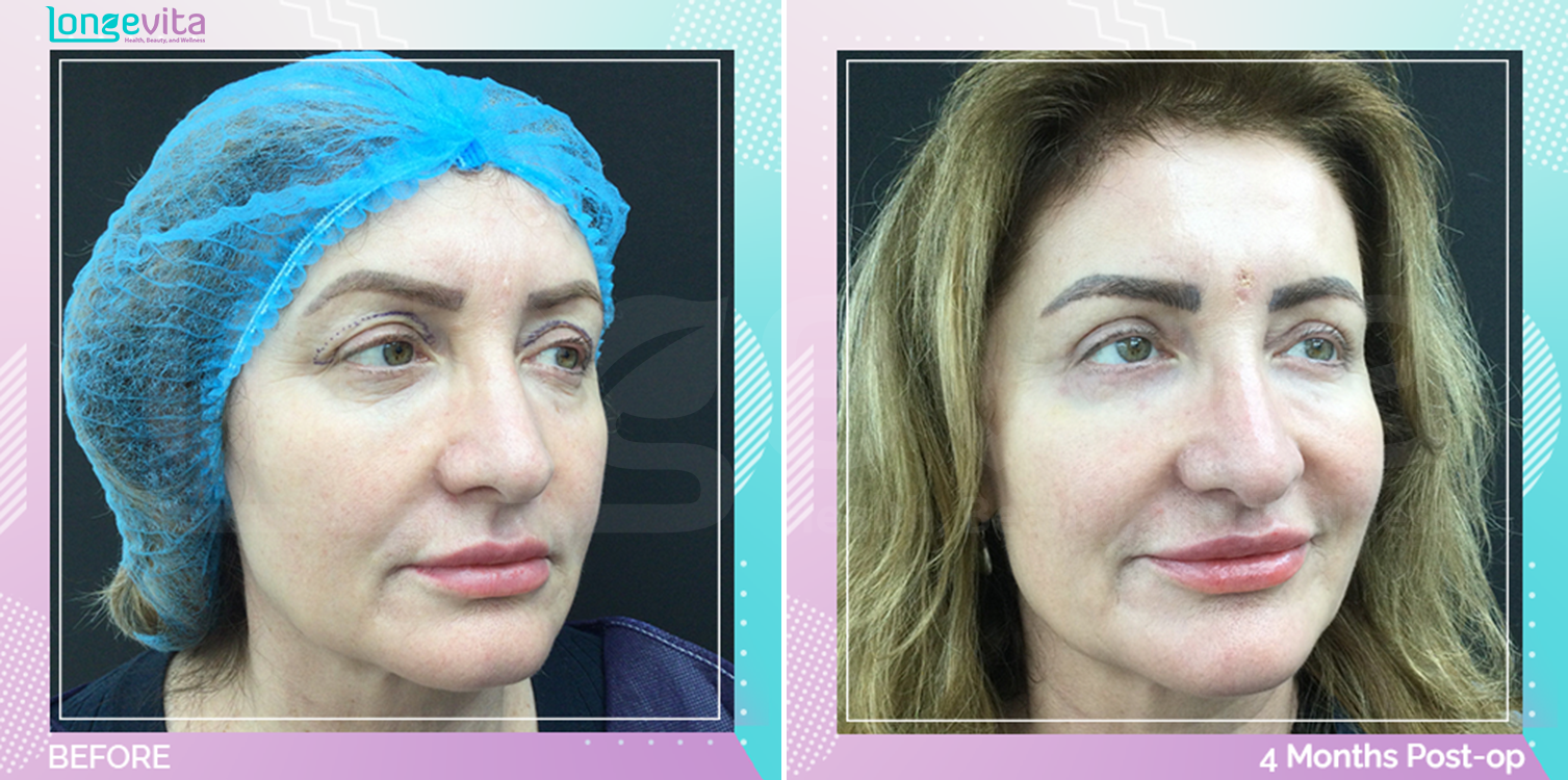 Eyelid before and after, Face