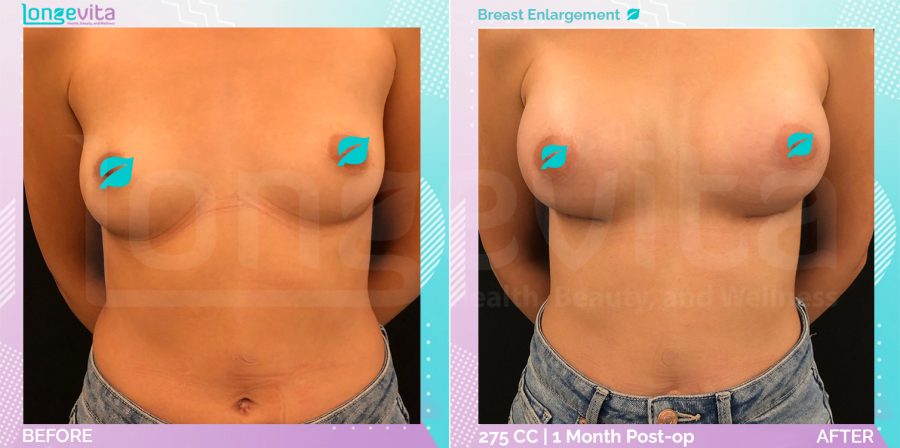 Breast Enlargement before and after, Breast
