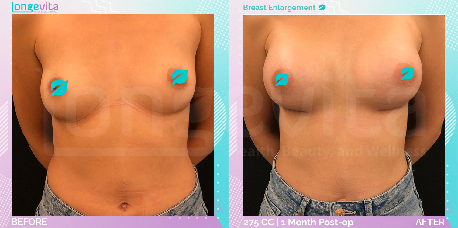 Breast Enlargement before and after, Breast