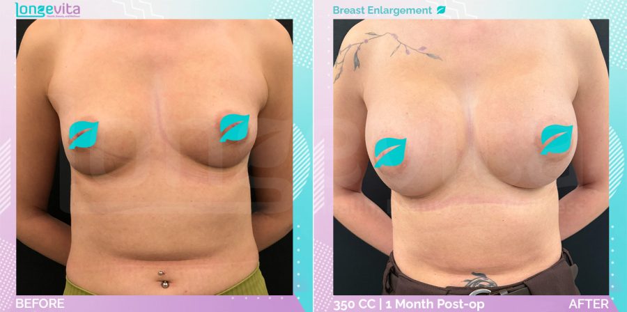 Breast Enlargement before and after, Breast