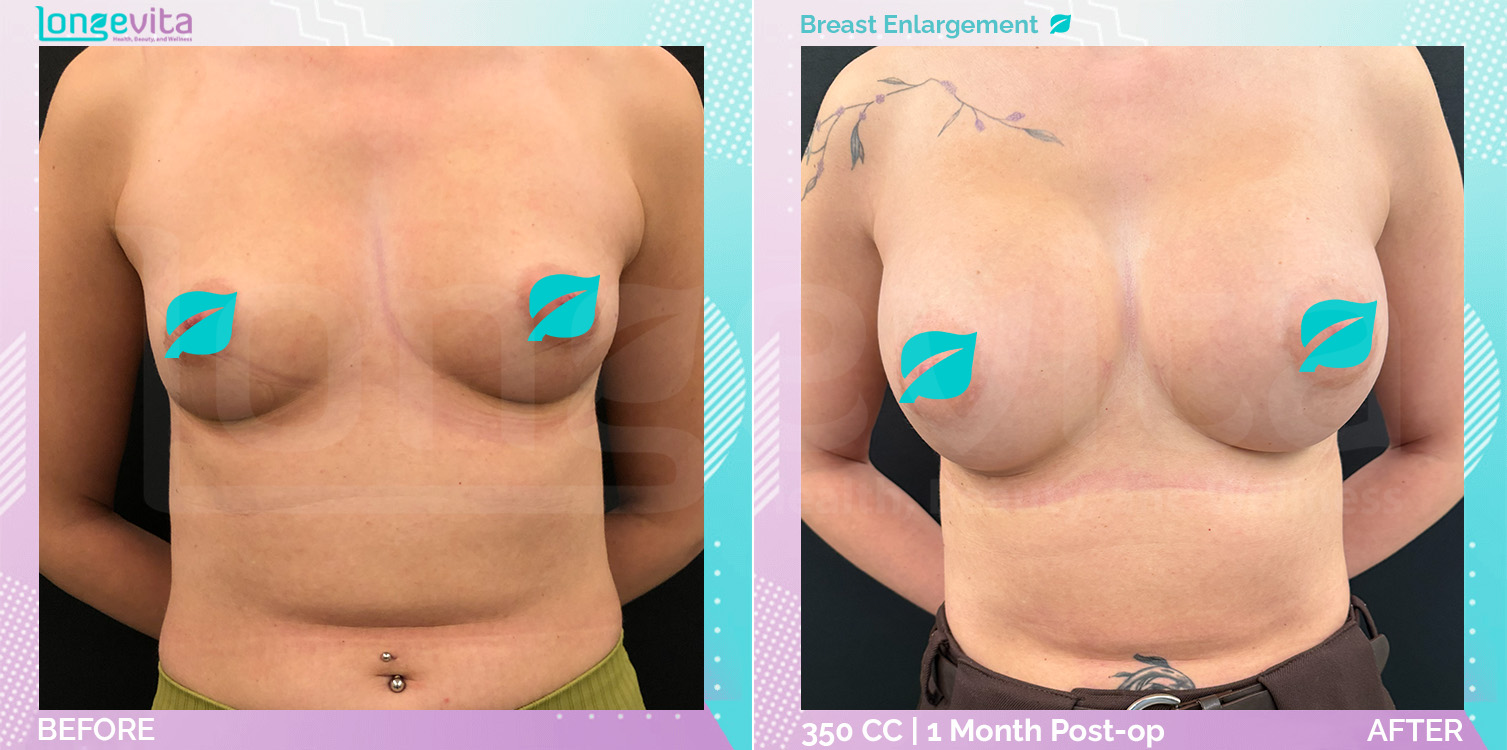 Breast Enlargement before and after, Breast