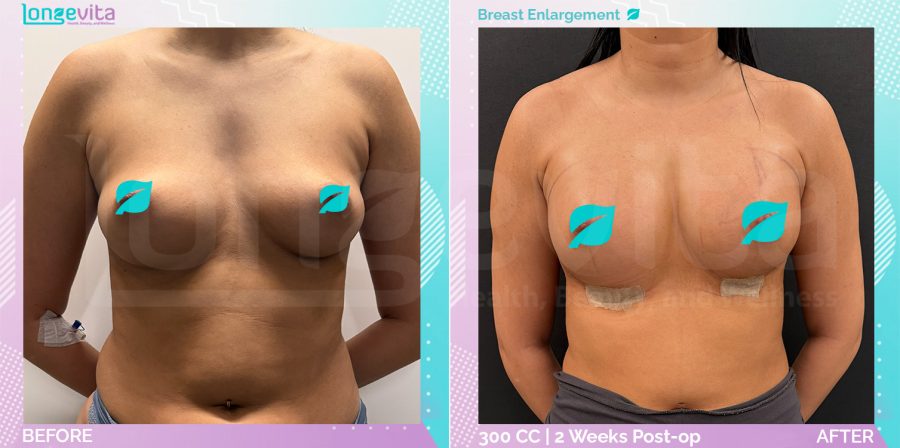 Breast Enlargement before and after, Breast