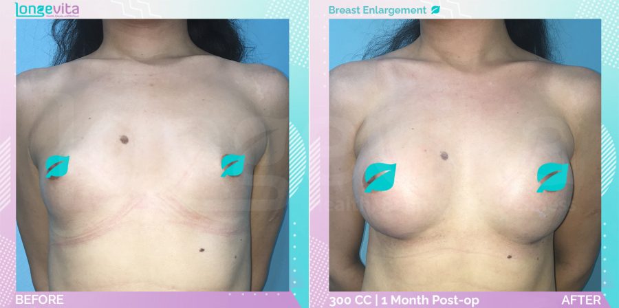 Breast Enlargement before and after, Breast