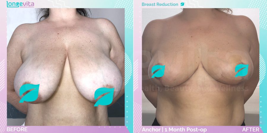 Breast Reduction before and after, Breast