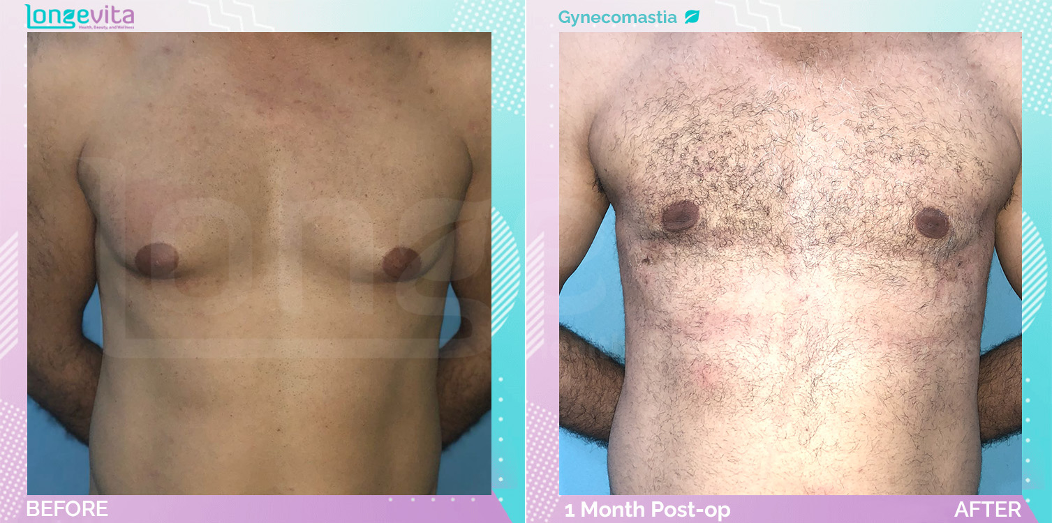 Gynecomastia before and after, Breast