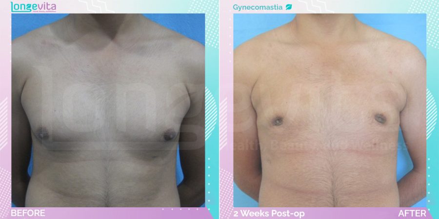 Gynecomastia before and after, Breast