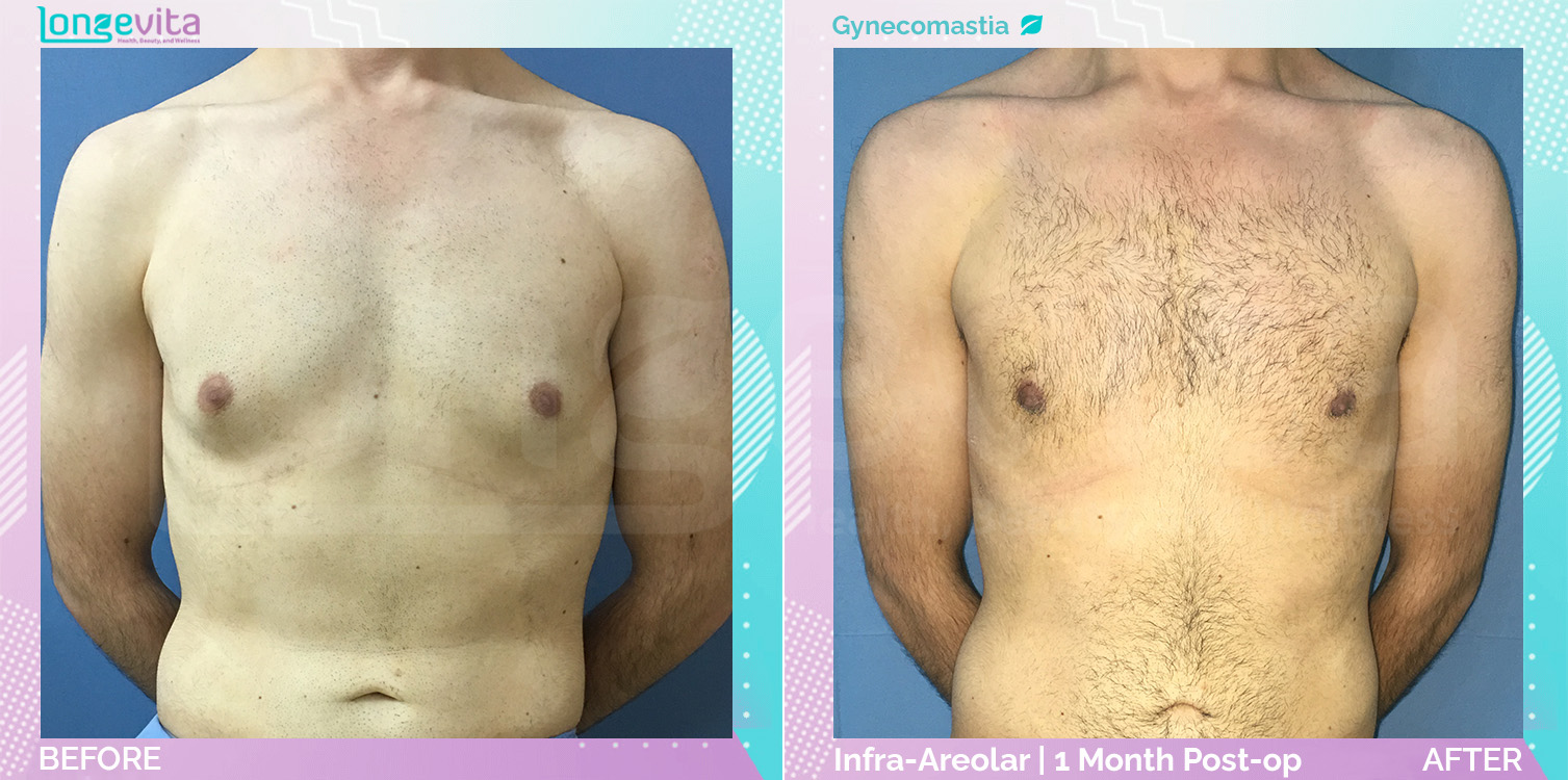 Gynecomastia before and after, Breast