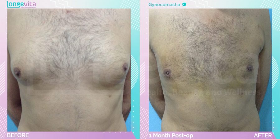 Gynecomastia before and after, Breast