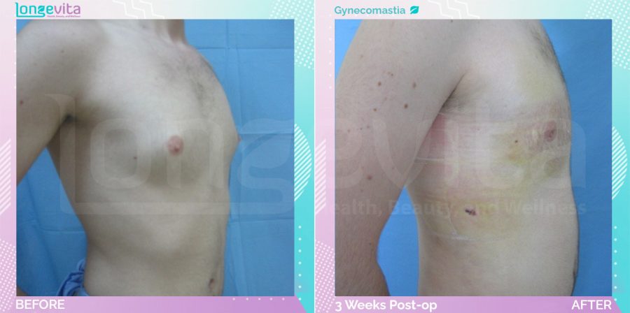 Gynecomastia before and after, Breast